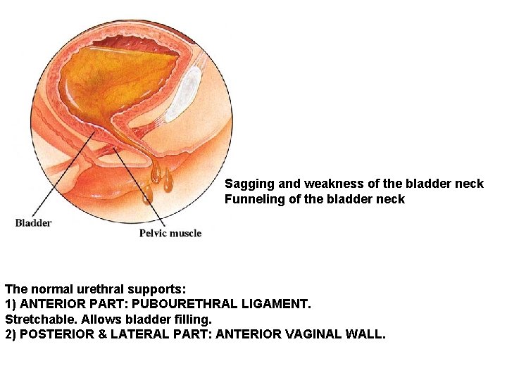 Sagging and weakness of the bladder neck Funneling of the bladder neck The normal