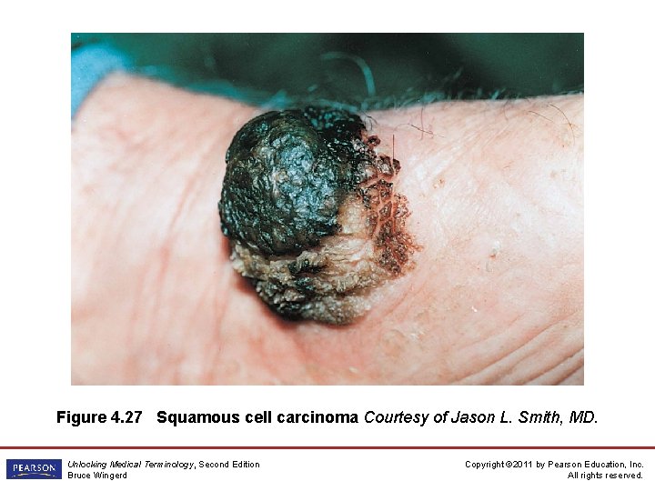 Figure 4. 27 Squamous cell carcinoma Courtesy of Jason L. Smith, MD. Unlocking Medical