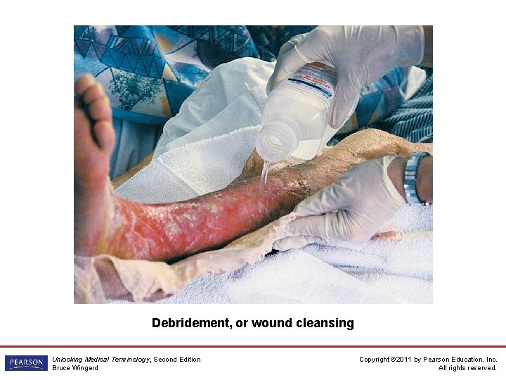 Debridement, or wound cleansing Unlocking Medical Terminology, Second Edition Bruce Wingerd Copyright © 2011