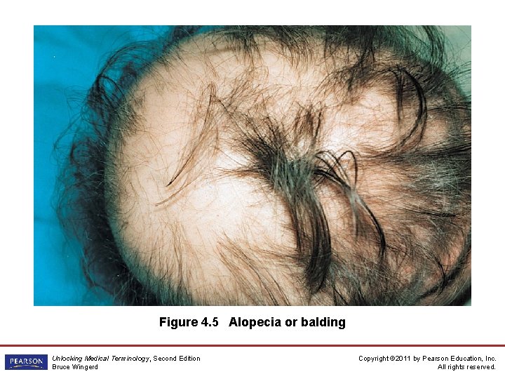 Figure 4. 5 Alopecia or balding Unlocking Medical Terminology, Second Edition Bruce Wingerd Copyright