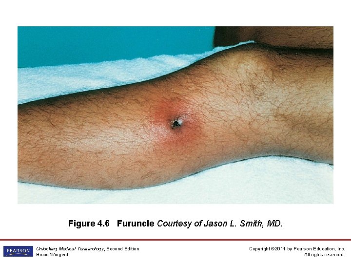 Figure 4. 6 Furuncle Courtesy of Jason L. Smith, MD. Unlocking Medical Terminology, Second