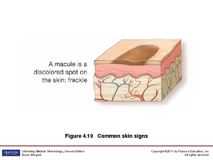 Figure 4. 10 Common skin signs. Unlocking Medical Terminology, Second Edition Bruce Wingerd Copyright