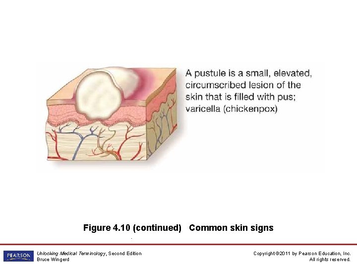 Figure 4. 10 (continued) Common skin signs. Unlocking Medical Terminology, Second Edition Bruce Wingerd