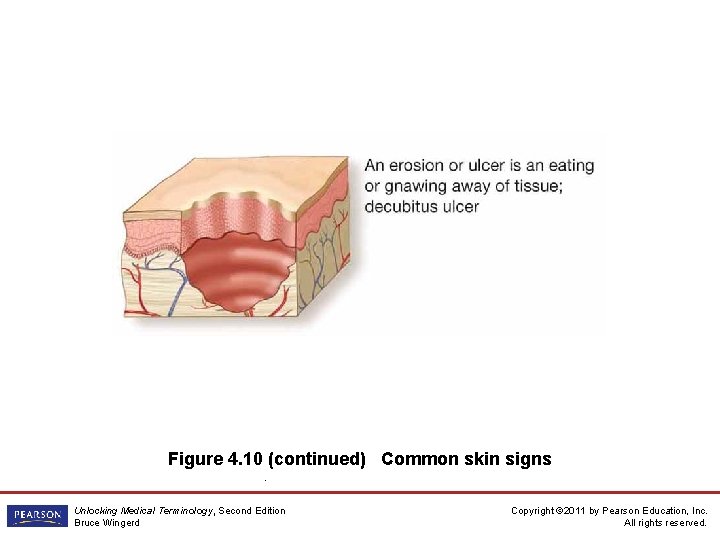 Figure 4. 10 (continued) Common skin signs. Unlocking Medical Terminology, Second Edition Bruce Wingerd