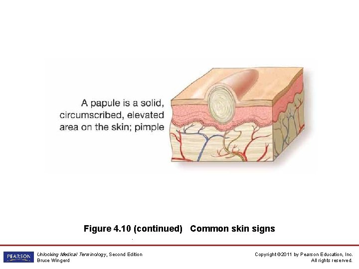 Figure 4. 10 (continued) Common skin signs. Unlocking Medical Terminology, Second Edition Bruce Wingerd