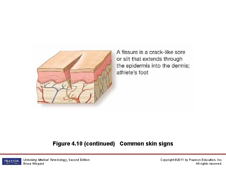 Figure 4. 10 (continued) Common skin signs. Unlocking Medical Terminology, Second Edition Bruce Wingerd