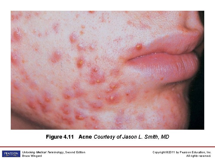 Figure 4. 11 Acne Courtesy of Jason L. Smith, MD Unlocking Medical Terminology, Second