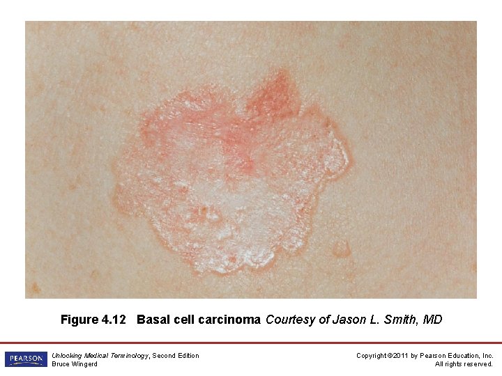 Figure 4. 12 Basal cell carcinoma Courtesy of Jason L. Smith, MD Unlocking Medical