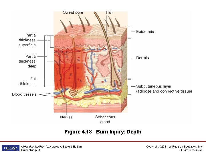 Figure 4. 13 Burn Injury: Depth Unlocking Medical Terminology, Second Edition Bruce Wingerd Copyright