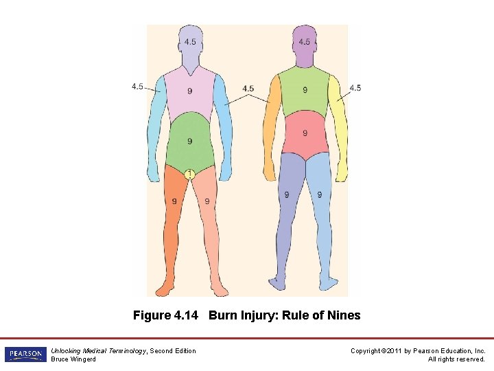 Figure 4. 14 Burn Injury: Rule of Nines Unlocking Medical Terminology, Second Edition Bruce