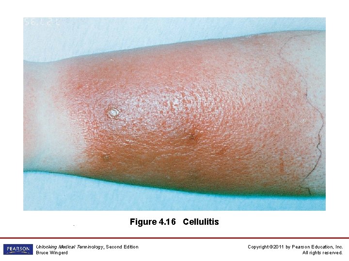 . Figure 4. 16 Cellulitis Unlocking Medical Terminology, Second Edition Bruce Wingerd Copyright ©