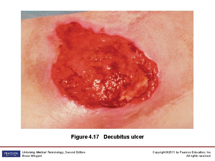 Figure 4. 17 Decubitus ulcer Unlocking Medical Terminology, Second Edition Bruce Wingerd Copyright ©