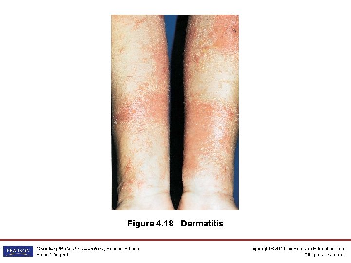 Figure 4. 18 Dermatitis Unlocking Medical Terminology, Second Edition Bruce Wingerd Copyright © 2011