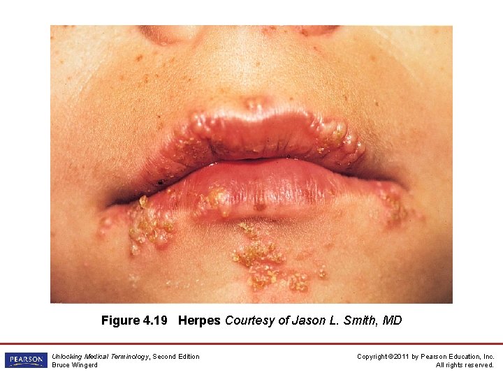 Figure 4. 19 Herpes Courtesy of Jason L. Smith, MD Unlocking Medical Terminology, Second