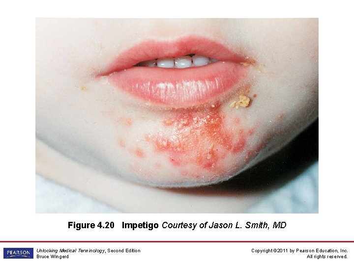 Figure 4. 20 Impetigo Courtesy of Jason L. Smith, MD Unlocking Medical Terminology, Second