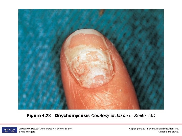 Figure 4. 23 Onychomycosis Courtesy of Jason L. Smith, MD Unlocking Medical Terminology, Second