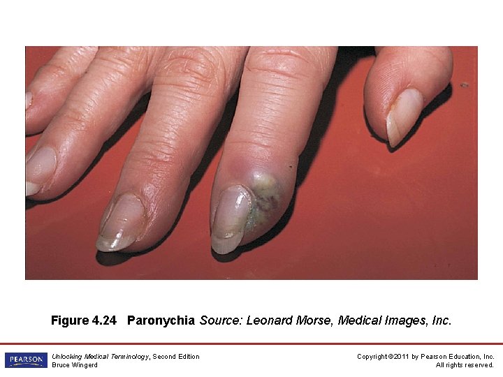 Figure 4. 24 Paronychia Source: Leonard Morse, Medical Images, Inc. Unlocking Medical Terminology, Second