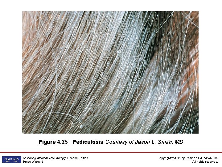 Figure 4. 25 Pediculosis Courtesy of Jason L. Smith, MD Unlocking Medical Terminology, Second