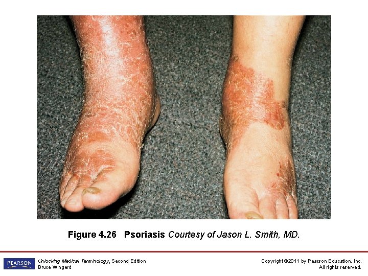 Figure 4. 26 Psoriasis Courtesy of Jason L. Smith, MD. Unlocking Medical Terminology, Second