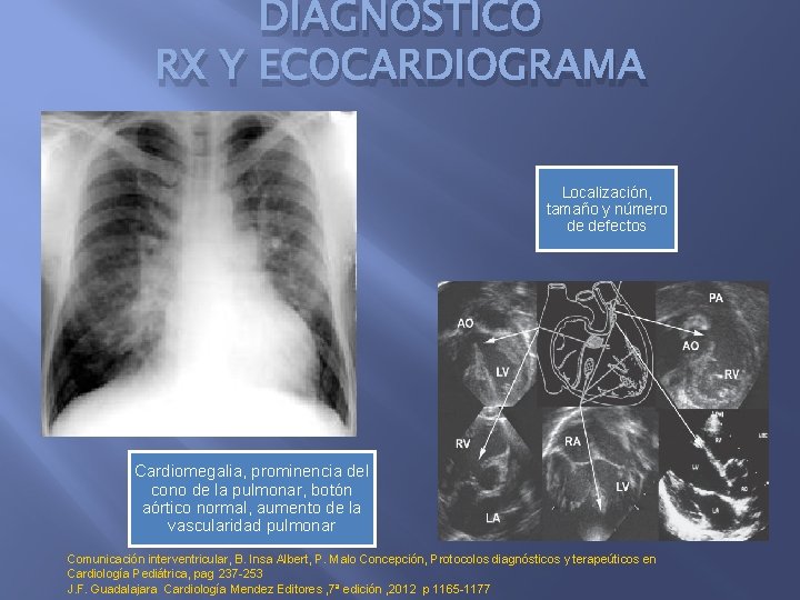 DIAGNÓSTICO RX Y ECOCARDIOGRAMA Localización, tamaño y número de defectos Cardiomegalia, prominencia del cono