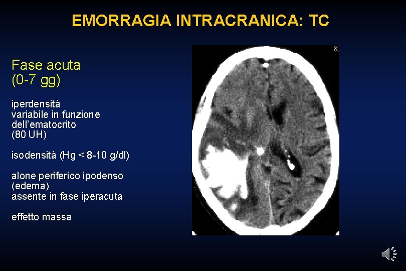 EMORRAGIA INTRACRANICA: TC Fase acuta (0 -7 gg) iperdensità variabile in funzione dell’ematocrito (80