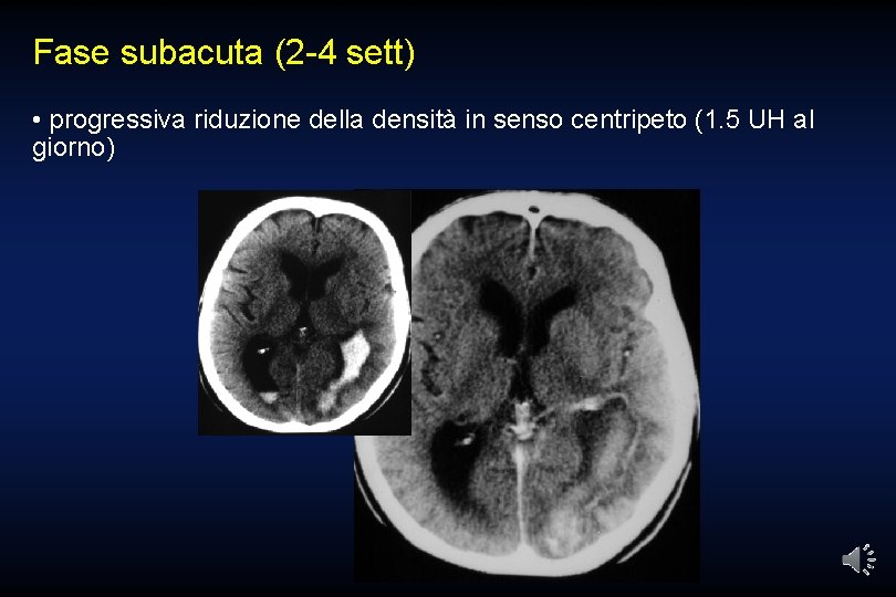 Fase subacuta (2 -4 sett) • progressiva riduzione della densità in senso centripeto (1.