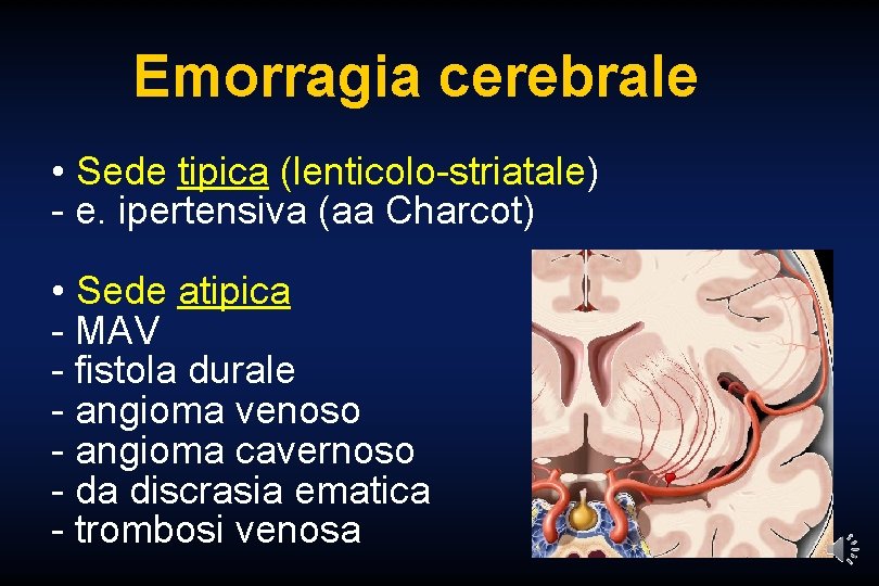 Emorragia cerebrale • Sede tipica (lenticolo-striatale) - e. ipertensiva (aa Charcot) • Sede atipica