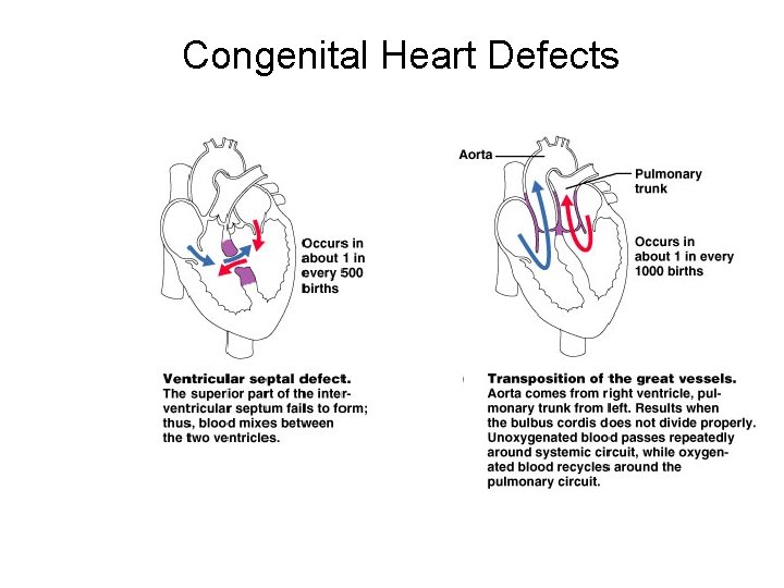 Congenital Heart Defects 
