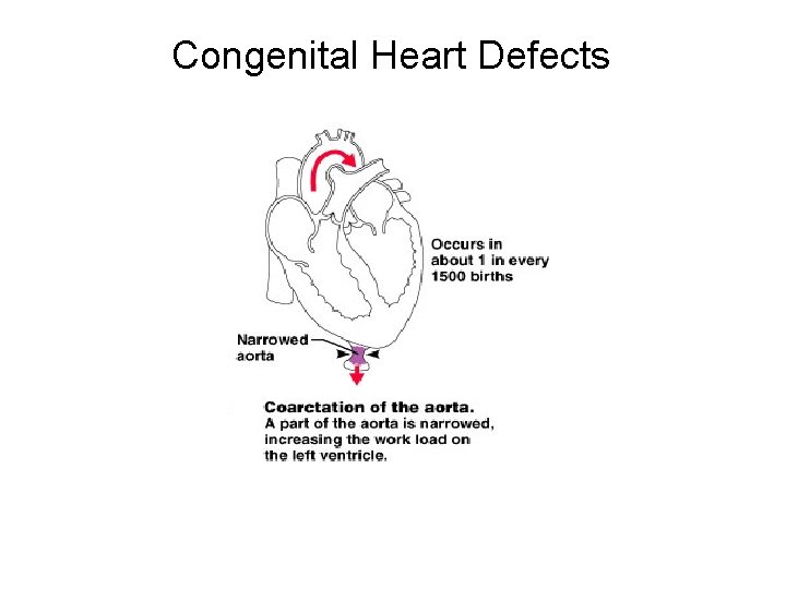 Congenital Heart Defects 