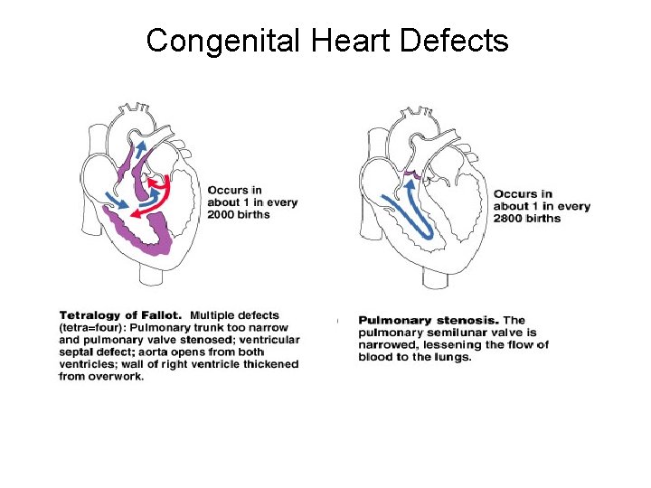 Congenital Heart Defects 