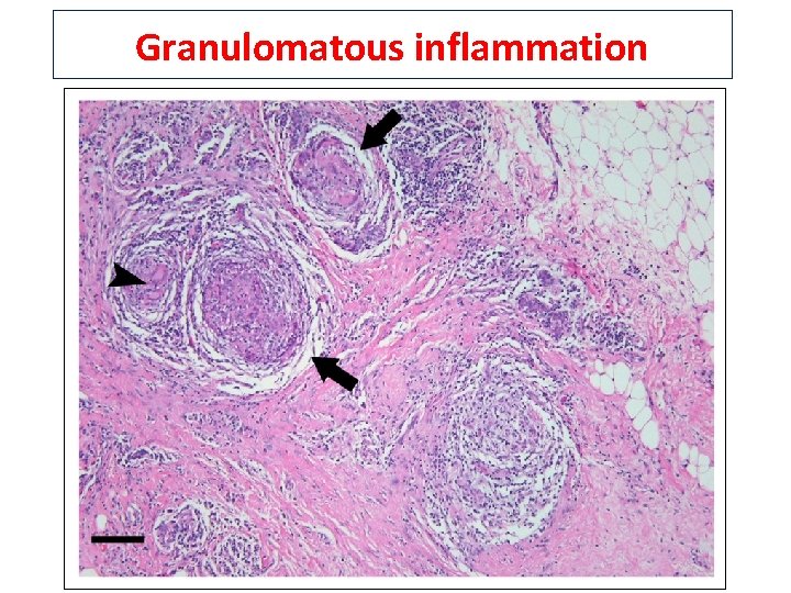 Granulomatous inflammation 