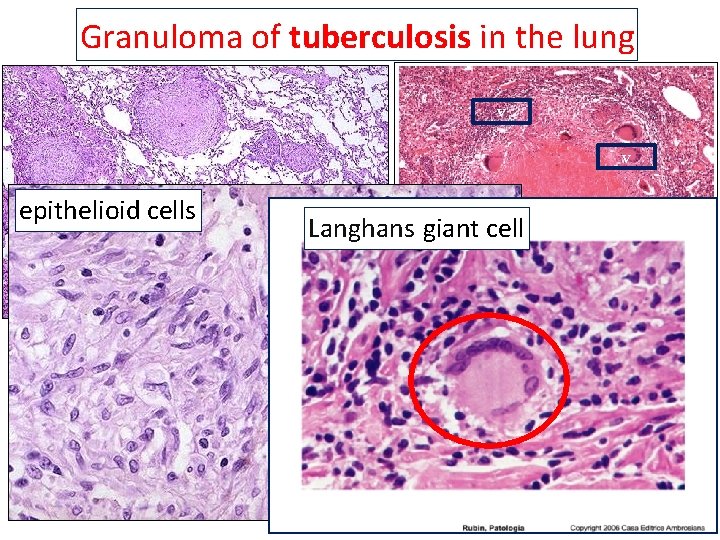 Granuloma of tuberculosis in the lung v v epithelioid cells Langhans giant cell 