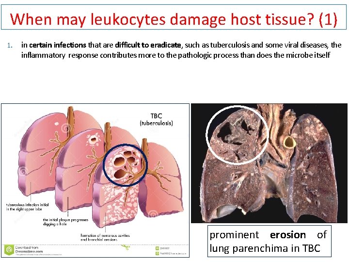 When may leukocytes damage host tissue? (1) 1. in certain infections that are difficult