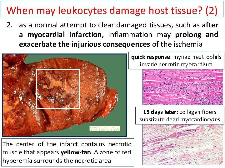 When may leukocytes damage host tissue? (2) 2. as a normal attempt to clear