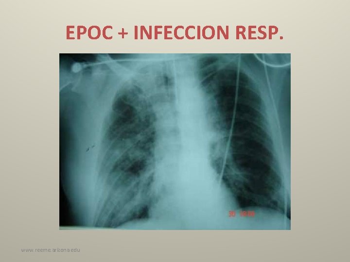EPOC + INFECCION RESP. www. reeme. arizona. edu 