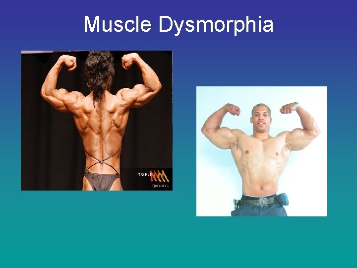 Muscle Dysmorphia 