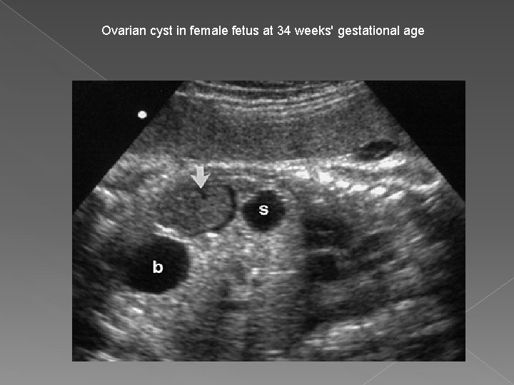 Ovarian cyst in female fetus at 34 weeks' gestational age 