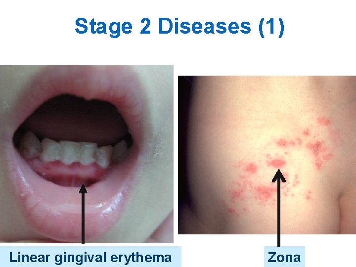 Stage 2 Diseases (1) Linear gingival erythema Zona 