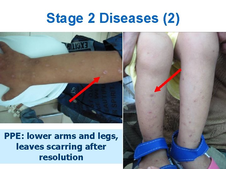 Stage 2 Diseases (2) PPE: lower arms and legs, leaves scarring after resolution 