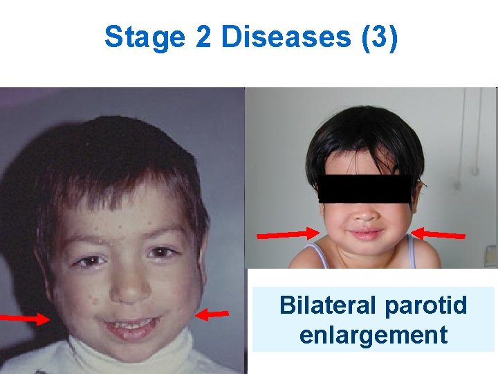 Stage 2 Diseases (3) Bilateral parotid enlargement 