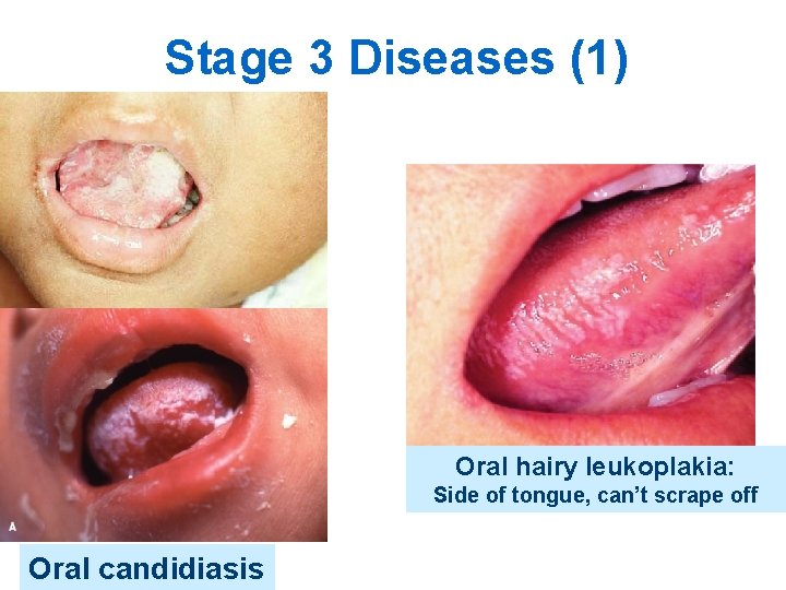 Stage 3 Diseases (1) Oral hairy leukoplakia: Side of tongue, can’t scrape off Oral