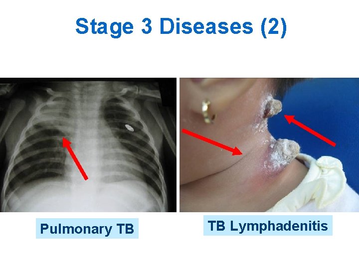 Stage 3 Diseases (2) Pulmonary TB TB Lymphadenitis 