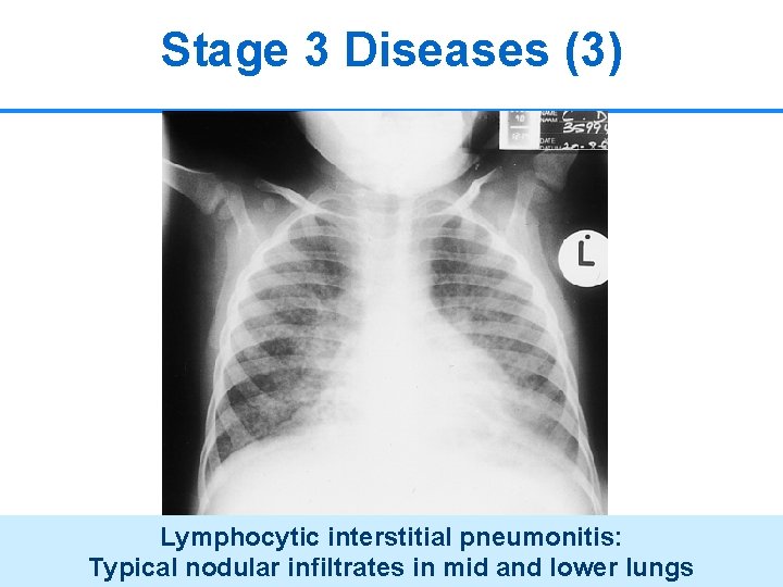 Stage 3 Diseases (3) Lymphocytic interstitial pneumonitis: Typical nodular infiltrates in mid and lower