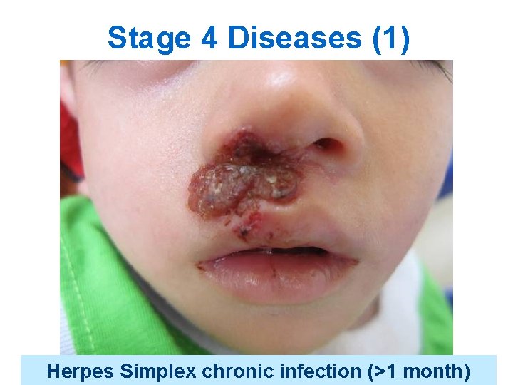 Stage 4 Diseases (1) Herpes Simplex chronic infection (>1 month) 