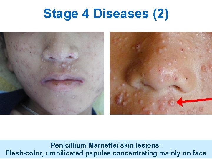 Stage 4 Diseases (2) Penicillium Marneffei skin lesions: Flesh-color, umbilicated papules concentrating mainly on