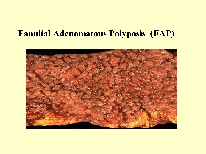 Familial Adenomatous Polyposis (FAP) 