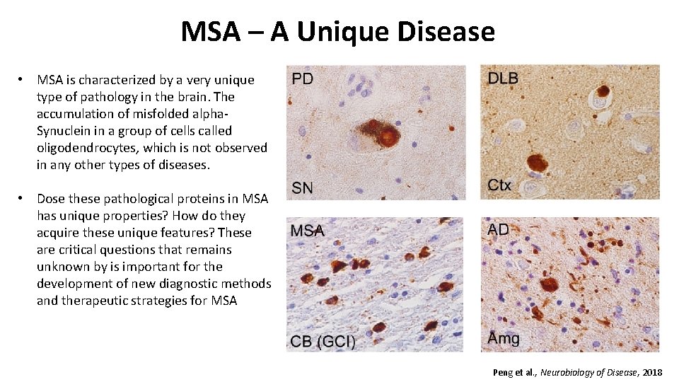 MSA – A Unique Disease • MSA is characterized by a very unique type