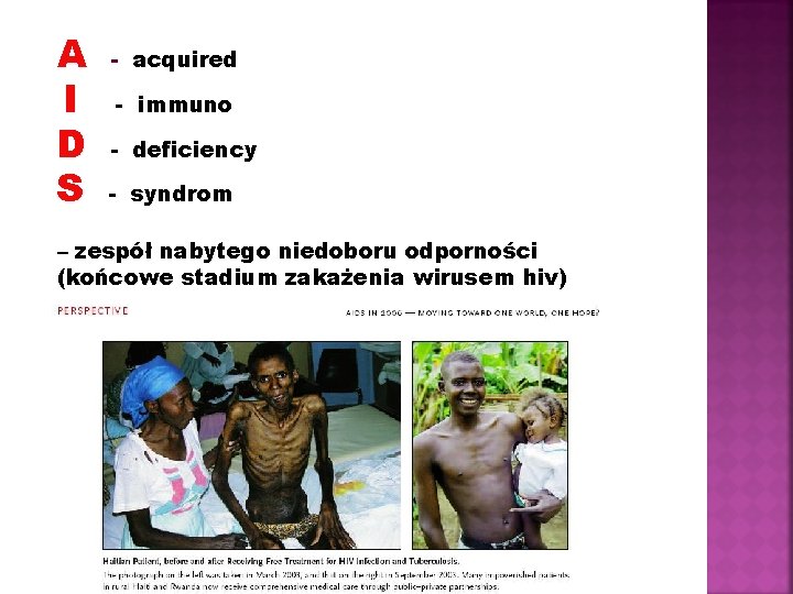 A I D S - acquired - immuno - deficiency - syndrom – zespół