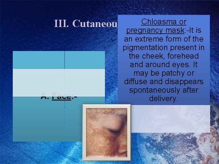 Chloasma or III. Cutaneous Changes A. Face: - pregnancy mask: -It is an extreme