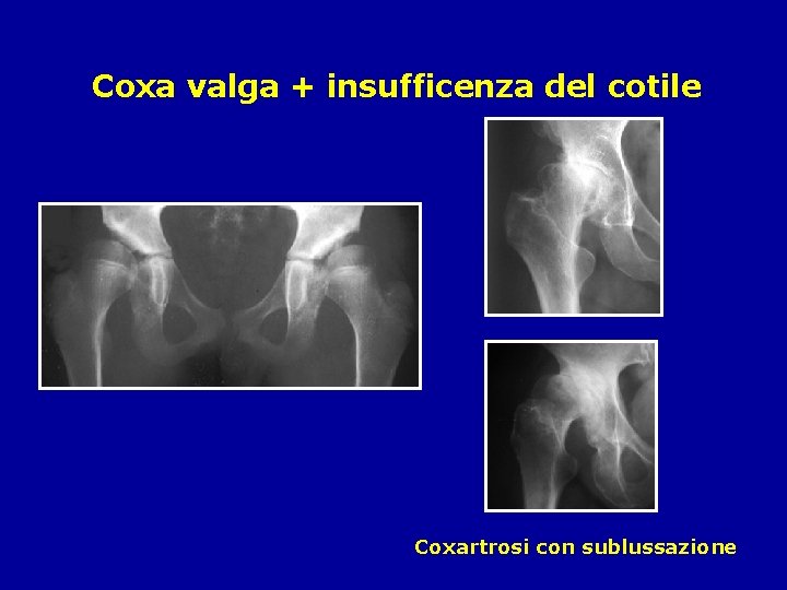 Coxa valga + insufficenza del cotile Coxartrosi con sublussazione 